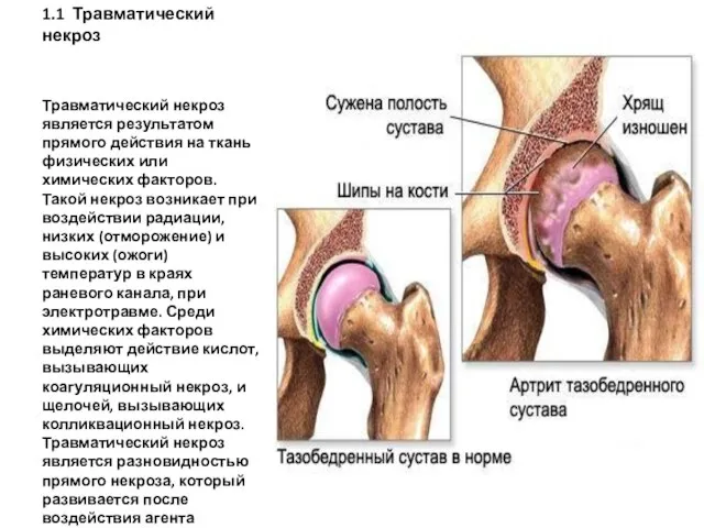 1.1 Травматический некроз Травматический некроз является результатом прямого действия на ткань физических