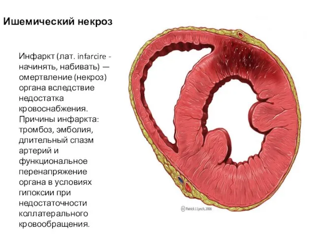 Ишемический некроз Инфаркт (лат. infarcire - начинять, набивать) — омертвление (некроз) органа