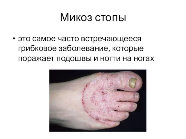 Микоз стопы это самое часто встречающееся грибковое заболевание, которые поражает подошвы и ногти на ногах