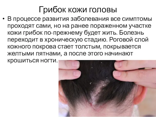 Грибок кожи головы В процессе развития заболевания все симптомы проходят сами, но