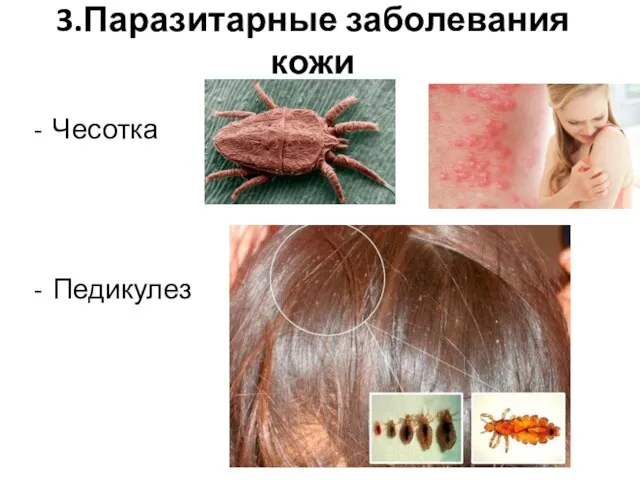 3.Паразитарные заболевания кожи Чесотка Педикулез