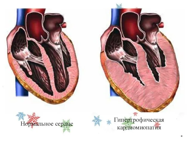 * Нормальное сердце Гипертрофическая кардиомиопатия
