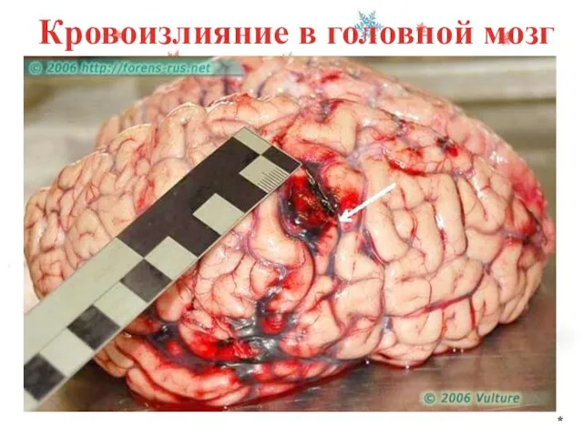 Кровоизлияние в головной мозг *