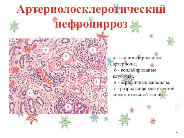 Артериолосклеротический нефроцирроз * а - гиалинизированные артериолы, б - коллабированые клубочки, в