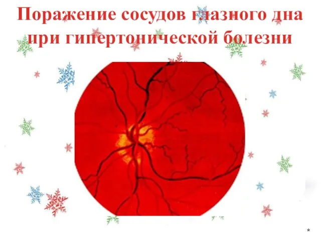 Поражение сосудов глазного дна при гипертонической болезни *