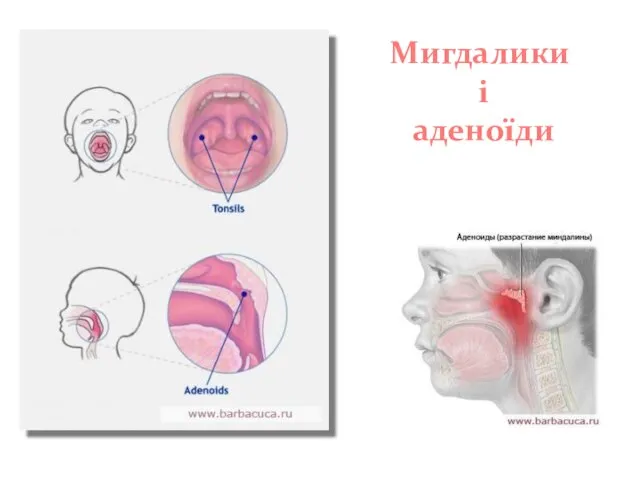 Мигдалики і аденоїди