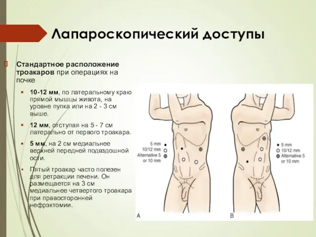 Лапароскопический доступы Стандартное расположение троакаров при операциях на почке 10-12 мм, по