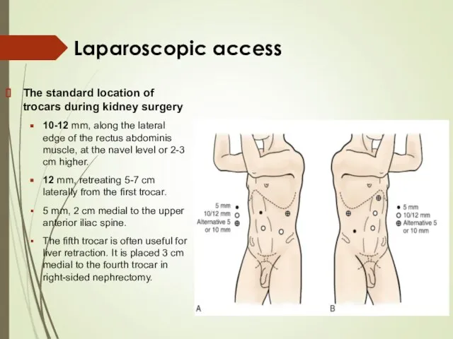 Laparoscopic access The standard location of trocars during kidney surgery 10-12 mm,