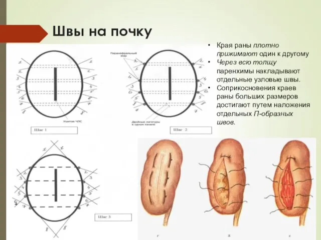 Швы на почку Края раны плотно прижимают один к другому Через всю