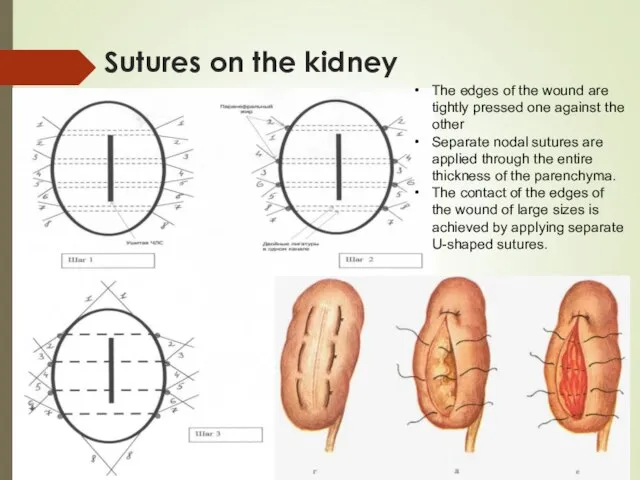 Sutures on the kidney The edges of the wound are tightly pressed