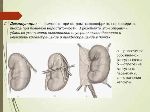 Декапсуляция — применяют при остром пиелонефрите, перинефрите, иногда при почечной недостаточности. В