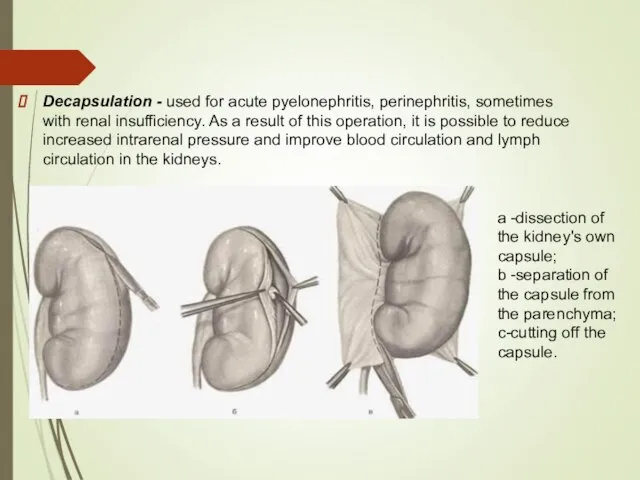 Decapsulation - used for acute pyelonephritis, perinephritis, sometimes with renal insufficiency. As