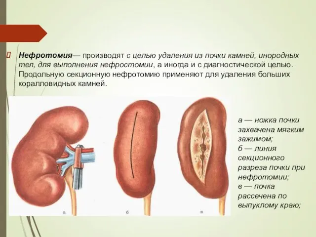 Нефротомия— производят с целью удаления из почки камней, инородных тел, для выполнения