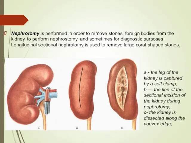 Nephrotomy is performed in order to remove stones, foreign bodies from the