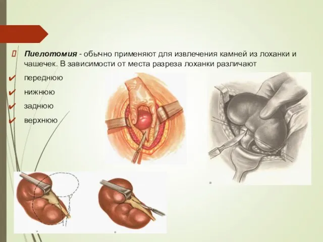 Пиелотомия - обычно применяют для извлечения камней из лоханки и чашечек. В