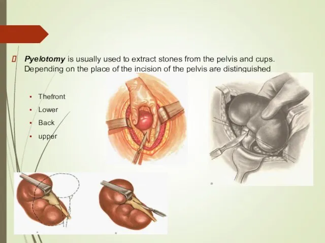 Pyelotomy is usually used to extract stones from the pelvis and cups.