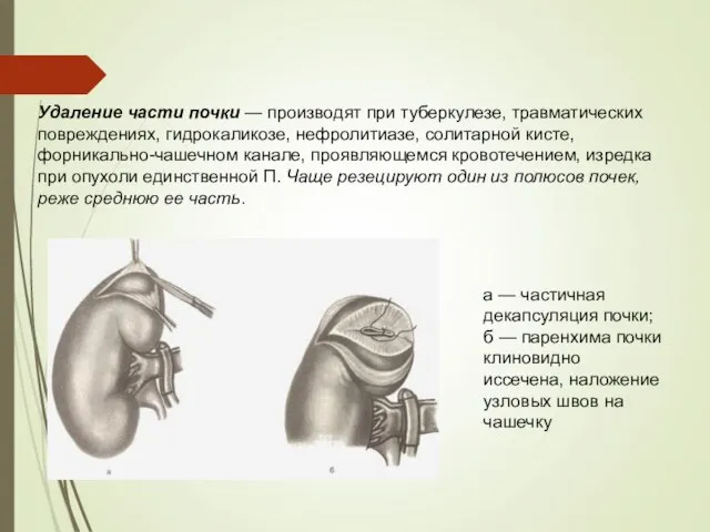 Удаление части почки — производят при туберкулезе, травматических повреждениях, гидрокаликозе, нефролитиазе, солитарной