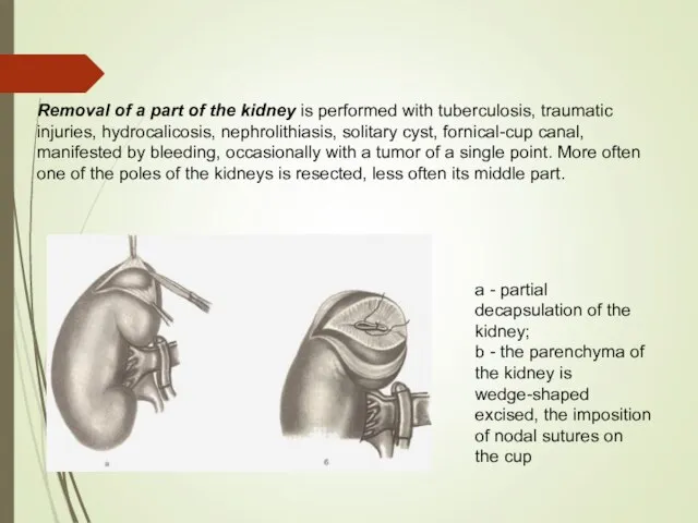 Removal of a part of the kidney is performed with tuberculosis, traumatic