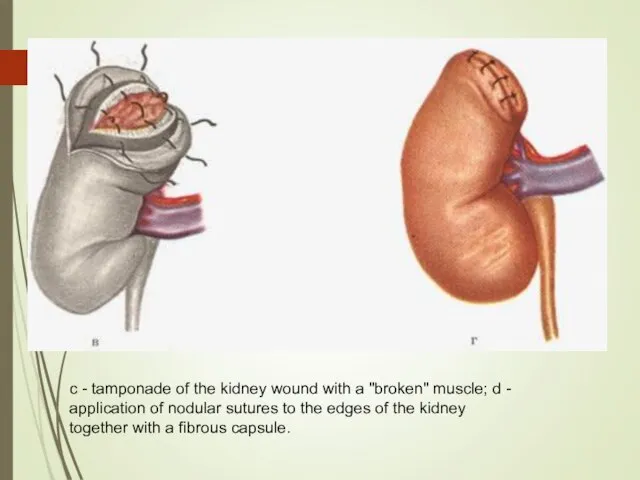 c - tamponade of the kidney wound with a "broken" muscle; d