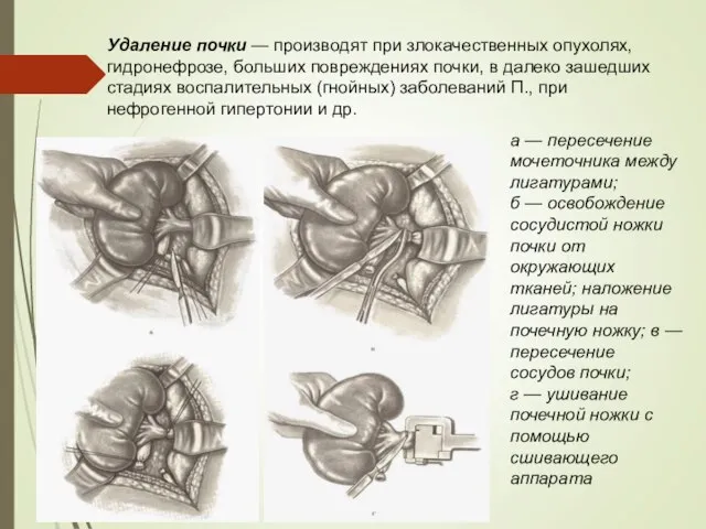 Удаление почки — производят при злокачественных опухолях, гидронефрозе, больших повреждениях почки, в