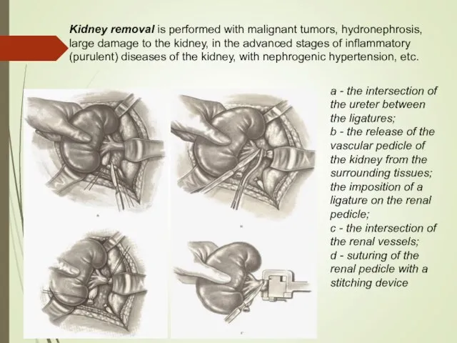 Kidney removal is performed with malignant tumors, hydronephrosis, large damage to the