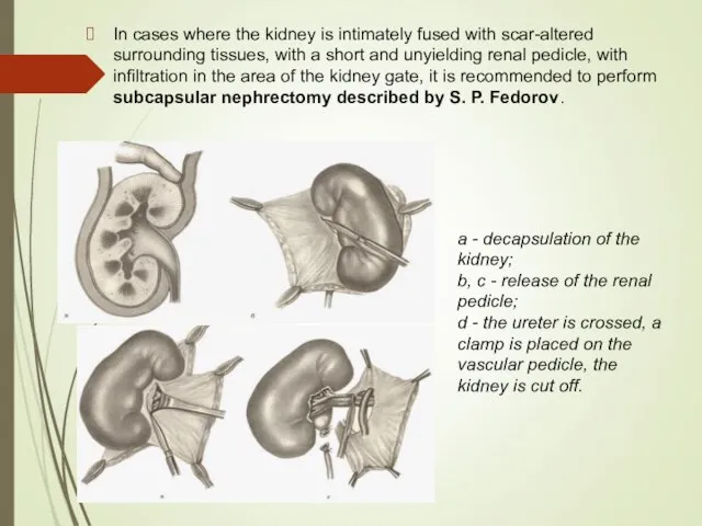 In cases where the kidney is intimately fused with scar-altered surrounding tissues,