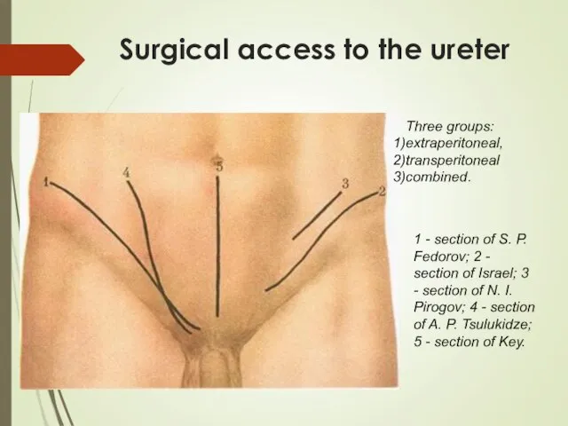 Surgical access to the ureter 1 - section of S. P. Fedorov;
