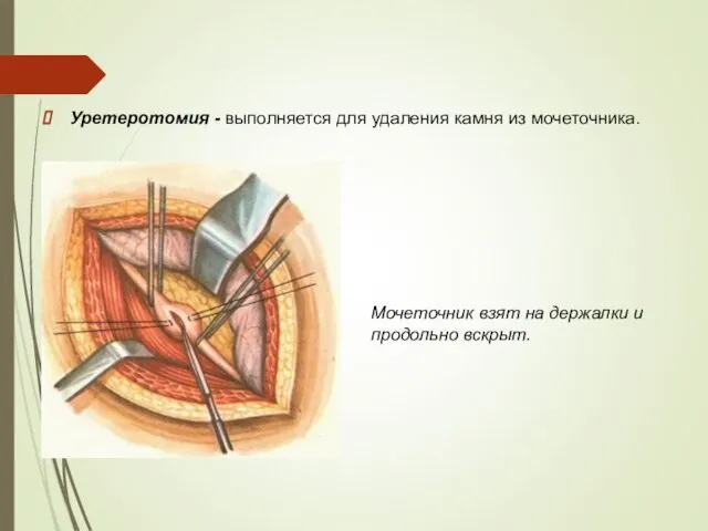 Уретеротомия - выполняется для удаления камня из мочеточника. Мочеточник взят на держалки и продольно вскрыт.