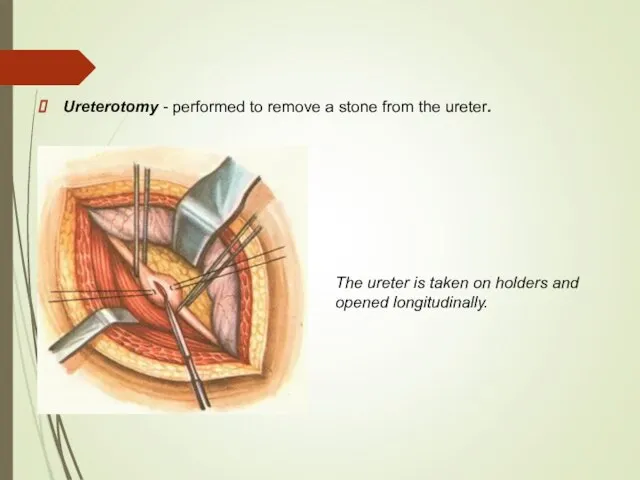 Ureterotomy - performed to remove a stone from the ureter. The ureter