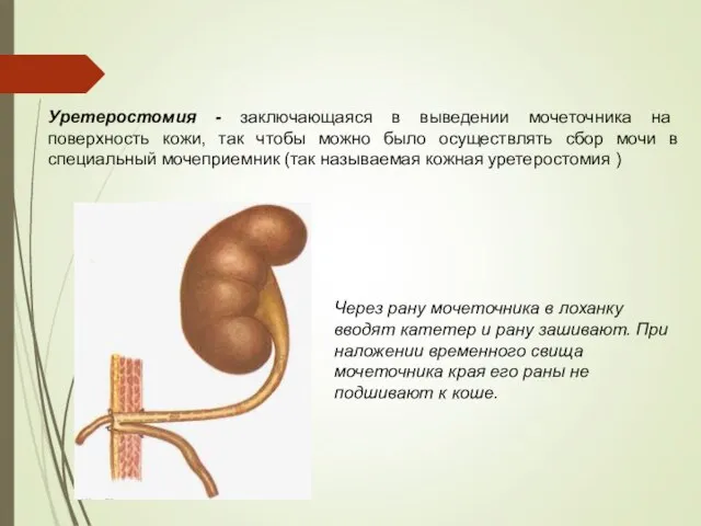 Уретеростомия - заключающаяся в выведении мочеточника на поверхность кожи, так чтобы можно