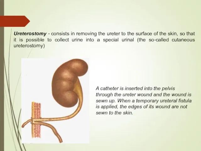 Ureterostomy - consists in removing the ureter to the surface of the