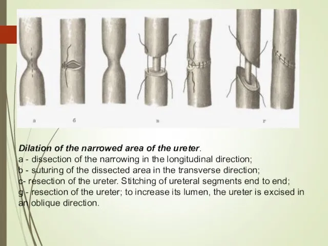 Dilation of the narrowed area of the ureter. a - dissection of