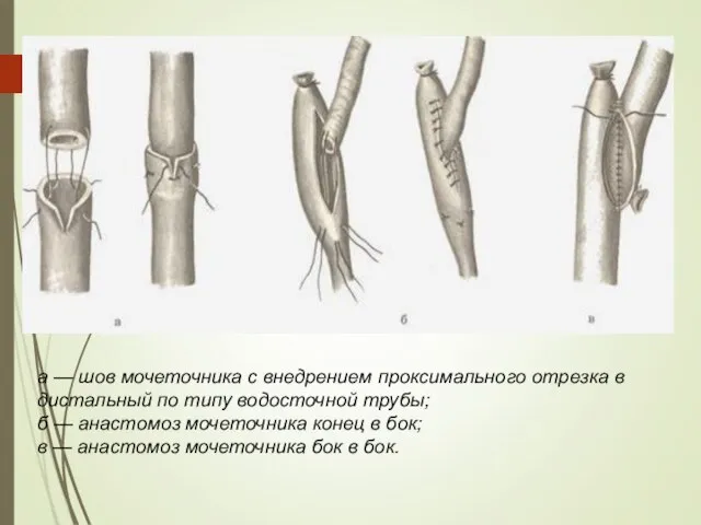 а — шов мочеточника с внедрением проксимального отрезка в дистальный по типу