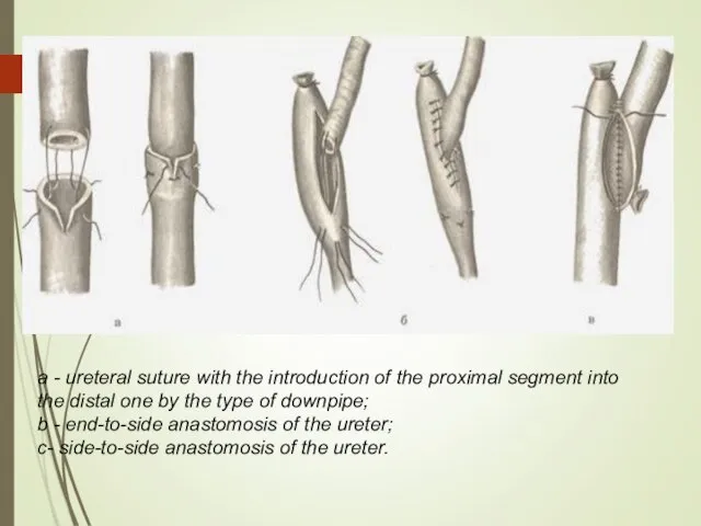 a - ureteral suture with the introduction of the proximal segment into