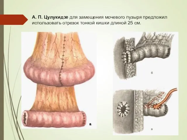 А. П. Цулукидзе для замещения мочевого пузыря предложил использовать отрезок тонкой кишки длиной 25 см.