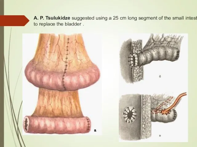 A. P. Tsulukidze suggested using a 25 cm long segment of the