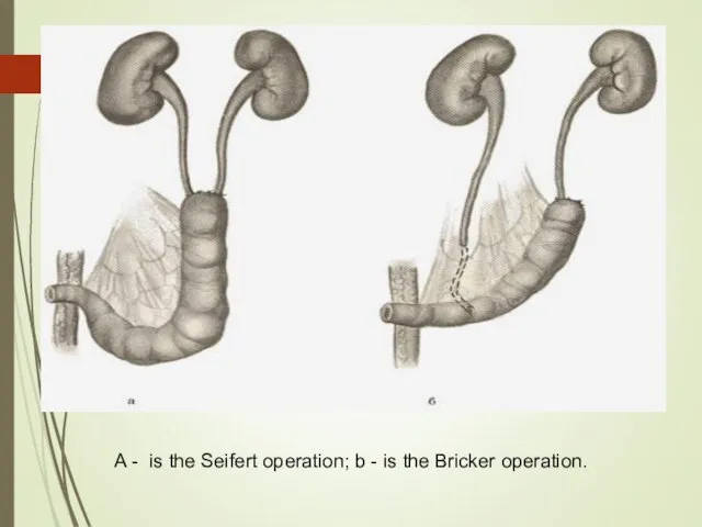 A - is the Seifert operation; b - is the Bricker operation.