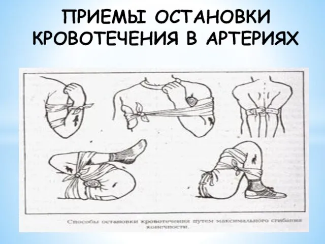 ПРИЕМЫ ОСТАНОВКИ КРОВОТЕЧЕНИЯ В АРТЕРИЯХ