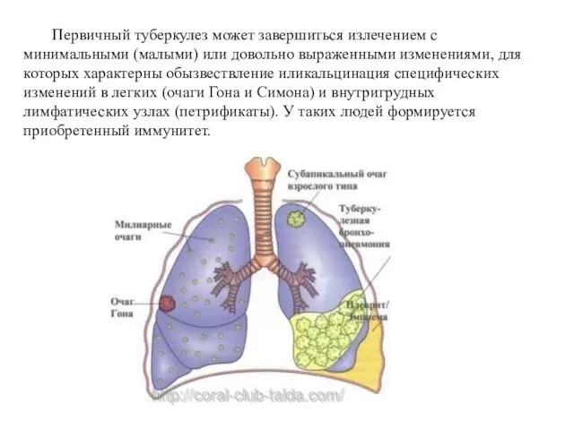 Первичный туберкулез может завершиться излечением с минимальными (малыми) или довольно выраженными изменениями,