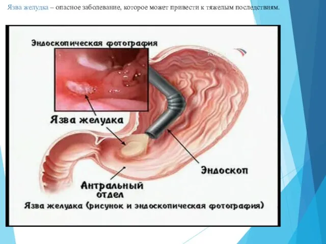 Язва желудка – опасное заболевание, которое может привести к тяжелым последствиям.