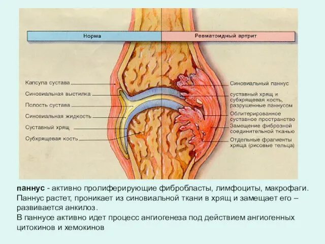 паннус - активно пролиферирующие фибробласты, лимфоциты, макрофаги. Паннус растет, проникает из синовиальной