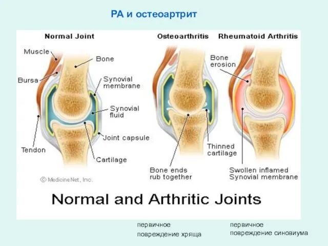 РА и остеоартрит первичное повреждение хряща первичное повреждение синовиума