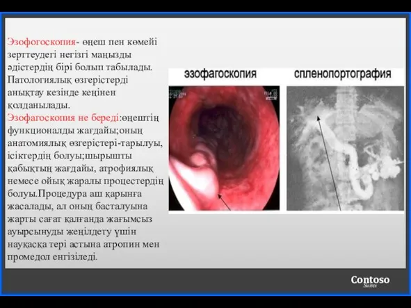 Эзофогоскопия- өңеш пен көмейі зерттеудегі негізгі маңызды әдістердің бірі болып табылады. Патологиялық