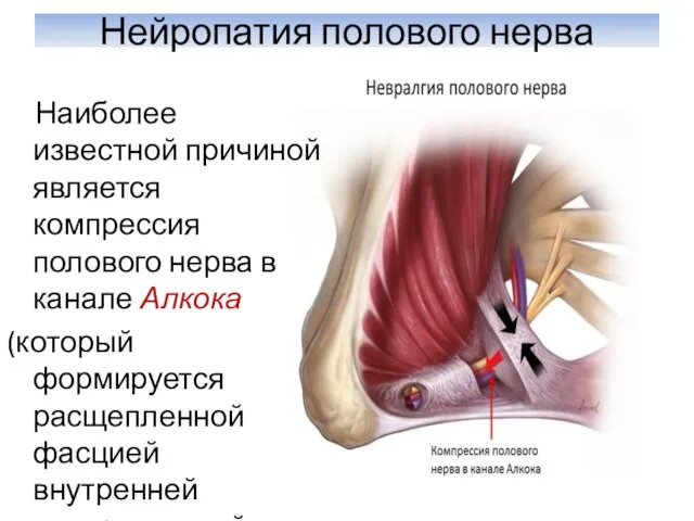 Нейропатия полового нерва Наиболее известной причиной является компрессия полового нерва в канале