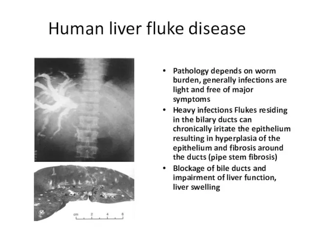 Human liver fluke disease Pathology depends on worm burden, generally infections are