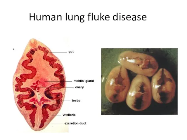 Human lung fluke disease