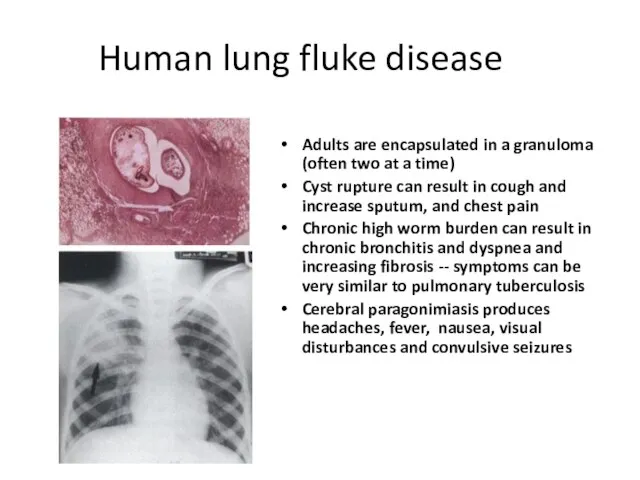 Human lung fluke disease Adults are encapsulated in a granuloma (often two