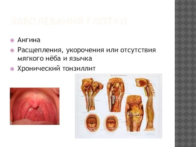 ЗАБОЛЕВАНИЯ ГЛОТКИ Ангина Расщепления, укорочения или отсутствия мягкого нёба и язычка Хронический тонзиллит