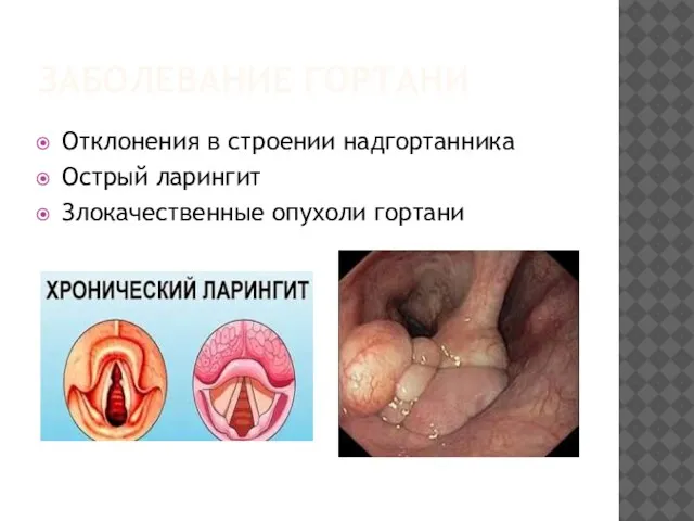 ЗАБОЛЕВАНИЕ ГОРТАНИ Отклонения в строении надгортанника Острый ларингит Злокачественные опухоли гортани