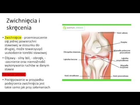 Zwichnięcia i skręcenia Zwichnięcie - przemieszczenie się jednej powierzchni stawowej w stosunku